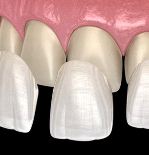 row of veneers being placed on several teeth