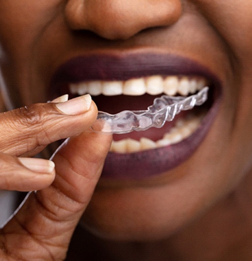 Woman placing clear aligners in Goodyear in her mouth