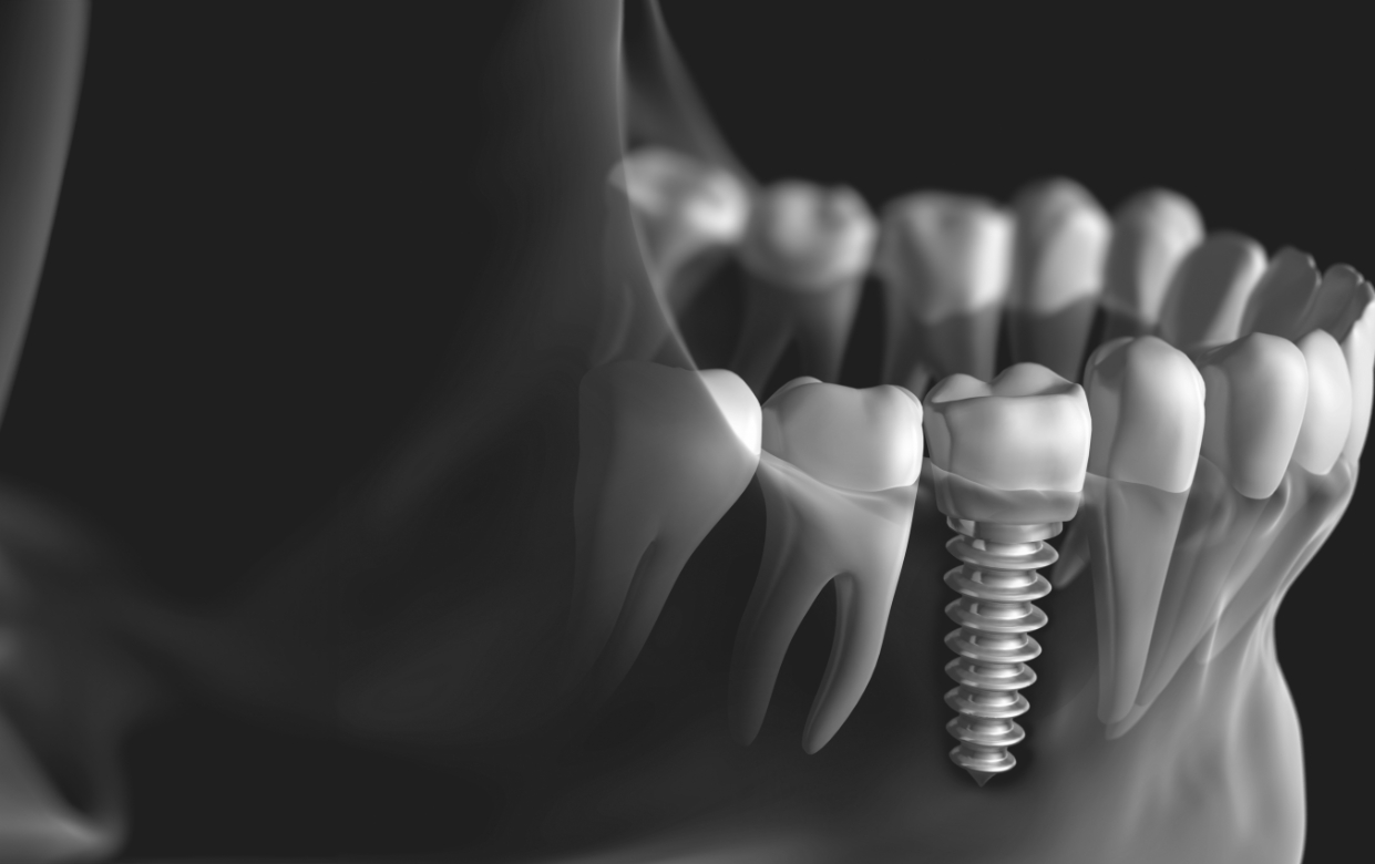 Older man sharing smile after dental implant tooth replacemetn