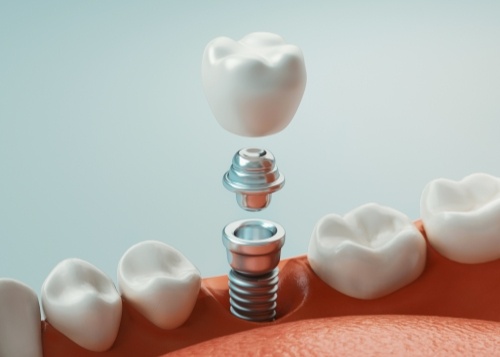 Animated dental implant supported replacement tooth placement