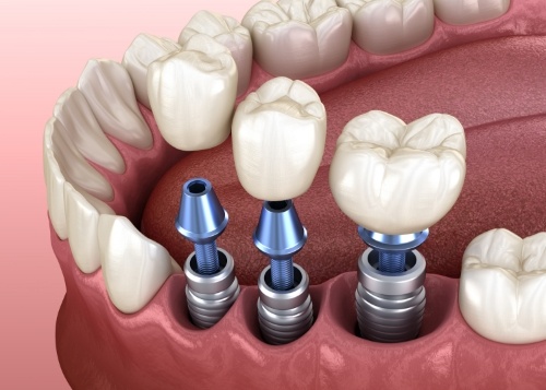 Man sharing healthy smile after dental implant tooth replacement