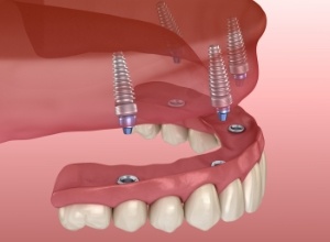 Animated all on four dental implant denture placement