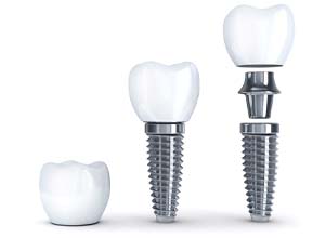 Diagram showing parts of dental implants in Goodyear