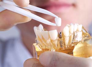 Dentist placing restoration onto dental implant inside model