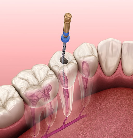 Animated tooth during root canal therapy process