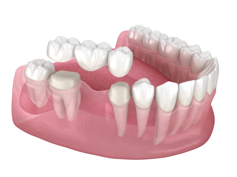 3D illustration of a dental bridge