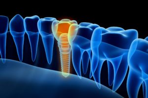 Digital image of a dental implant