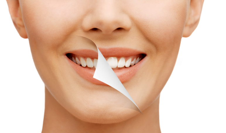 Woman with smile peeling off to reveal whiter teeth